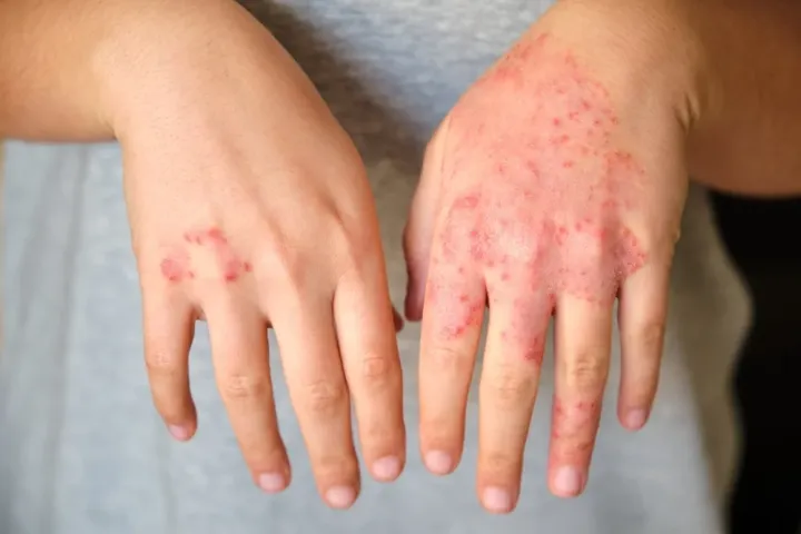 Dermatite atópica: por que ela é mais do que "pele seca" e como a ciência está mudando o tratamento