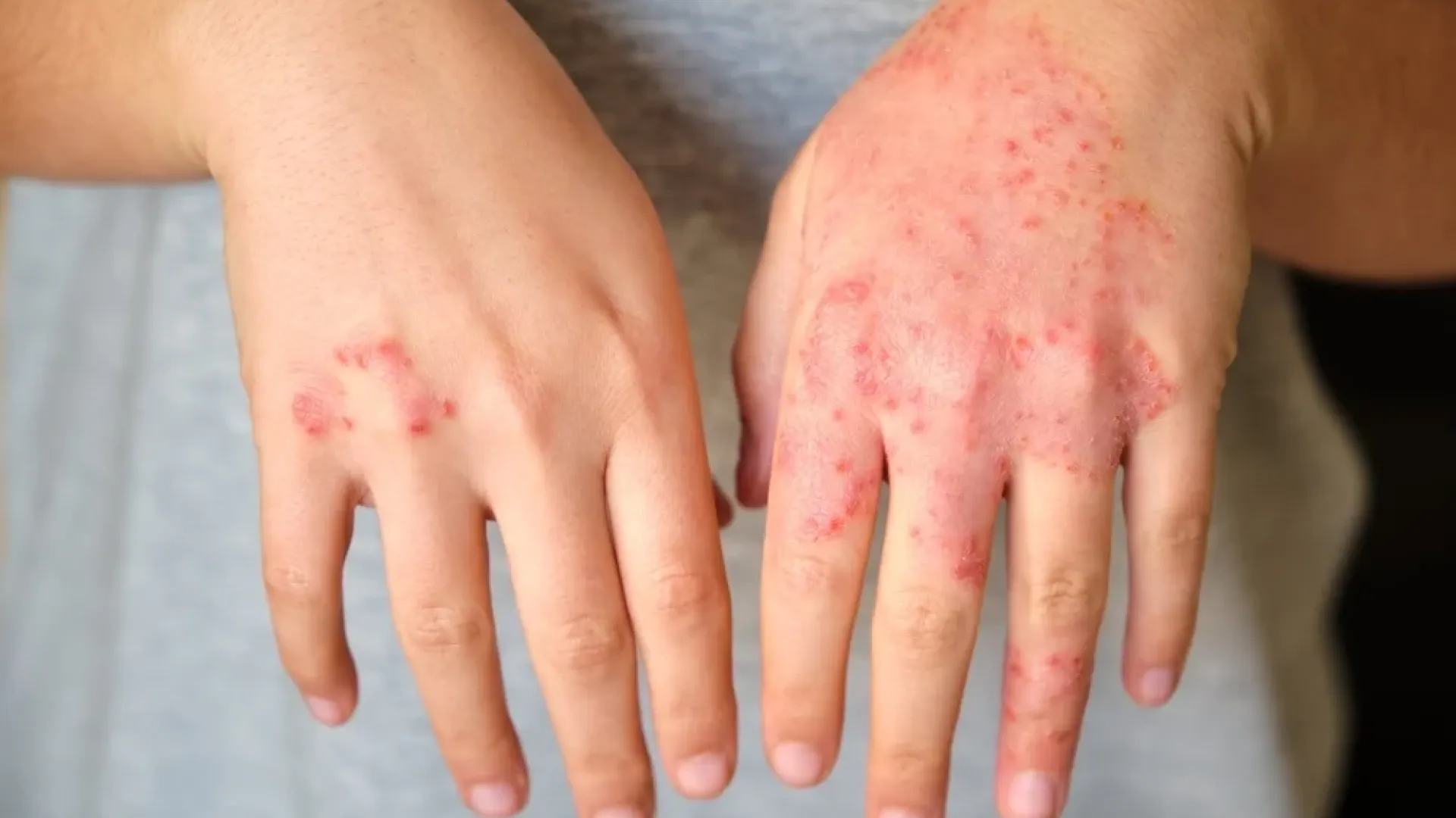 Dermatite atópica: quando cuidar da pele transforma a qualidade de vida